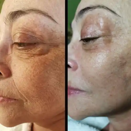 mikrodermabrasion reutlingen - ayza cosmetics
